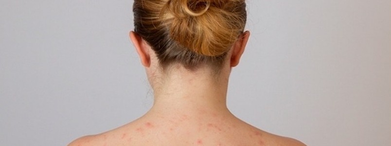 Descubra como evitar o aparecimento de acne nas costas