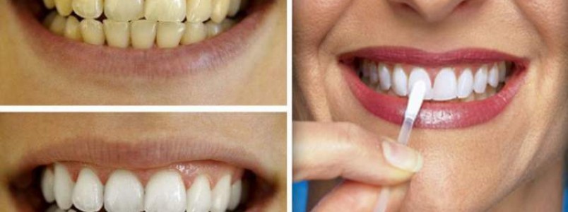 Tenha dentes brancos como nunca usando este método caseiro poderoso e barato