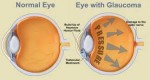 Glaucoma