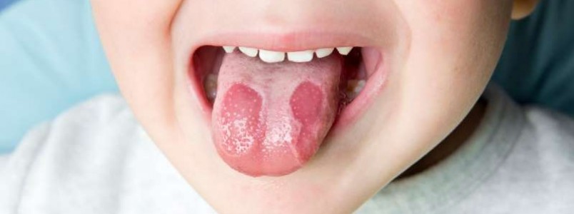 Fungo oral causa infecção bucal comum