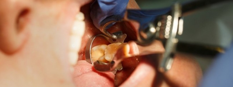Cientistas criam substncia que pode regenerar dentes e aposentar obturaes 