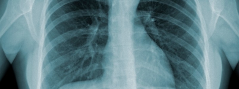 Cidades com extrema desigualdade sofrem mais com tuberculose