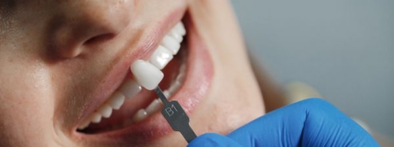 Faceta e lente de contato dental: saiba qual a diferena