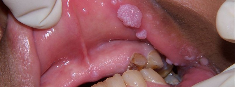 HPV na boca tem cura?  O que , sintomas, fotos e tratamentos