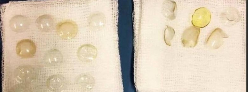 Médicos encontram 27 lentes de contato "perdidas" em olhos de paciente