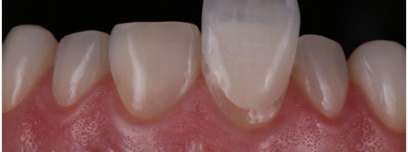 Lentes de contato dental  - saiba como deixar seu sorriso mais bonito 