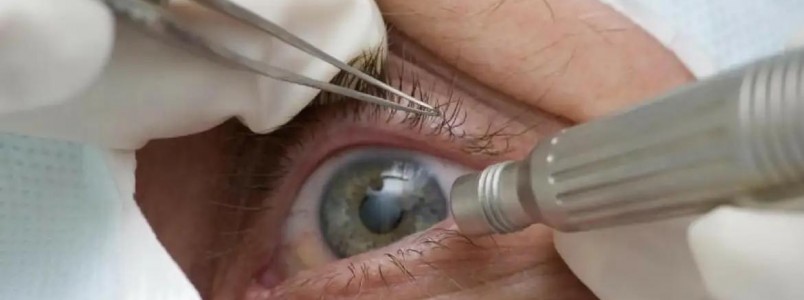 Mdicos alertam para riscos da cirurgia de mudana da cor dos olhos