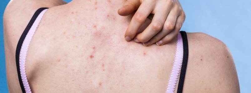 Espinhas além do rosto: como evitar acne nas costas ou outras partes do corpo?