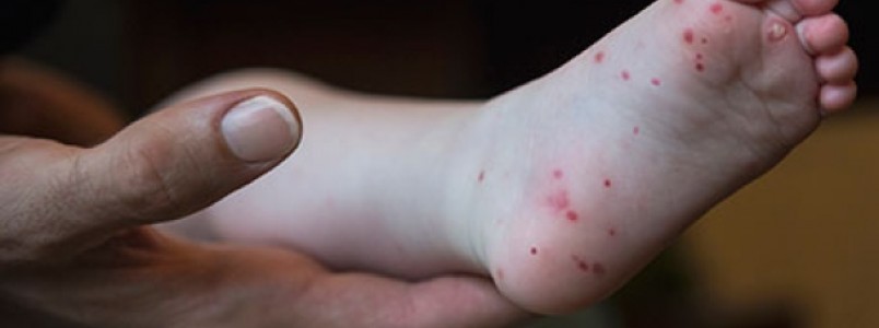 Surtos da síndrome mão-pé-boca já atingem 24 cidades em Minas e número de casos mais que triplica