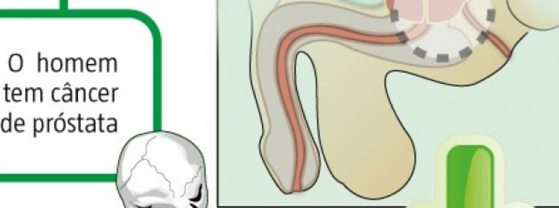 Pesquisa que busca conter o avano do cncer de Prstata procura voluntrios