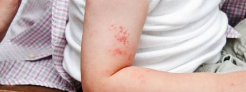 Você sabe o que é Herpes Zoster?