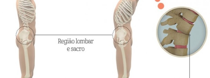 Espondilite Anquilosante: a importância do diagnóstico assertivo