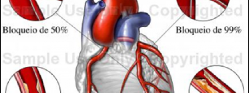 Doenças Cardiovasculares